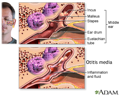 illustration of fluid, swelling, or an infection behind the eardrum that does not go away or keeps coming back